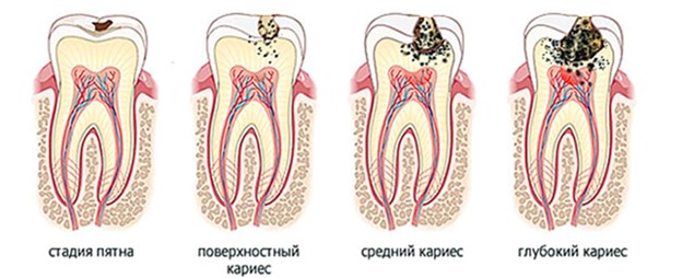 Как разрушается зуб